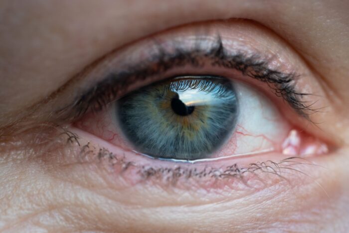 Alergia a lentes de contato? 5 maneiras de evitar esse desconforto