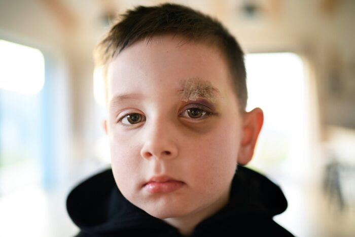Trauma ocular: o que é e quais os cuidados para a reabilitação da visão