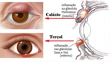 terçol